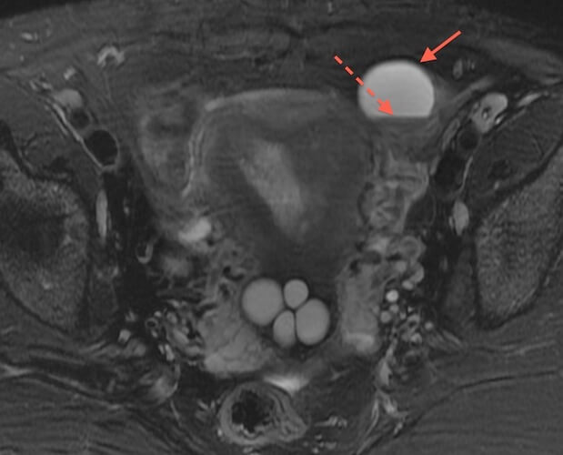 Note left ovarian endometrioma (arrow), with a characteristic fluid/fluid level (dashed arrow).