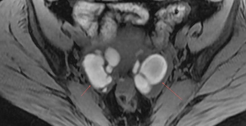 Bilateral ovarian endometriomas and right hematosalpinx with bright T1 signal, indicative of hemorrhage.