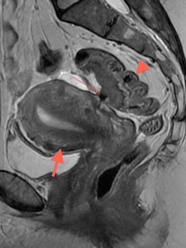 Another example of endometriosis, this time with deep endometriosis involving the bowel. Note tethering of bowel (thin arrrow) with bowel wall thickening behind uterus (thick arrow). For comparison note normal thickness of the posterior margin of the bowel (arrowhead)..