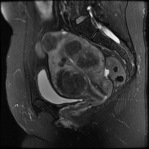 Fibroids Body Mri